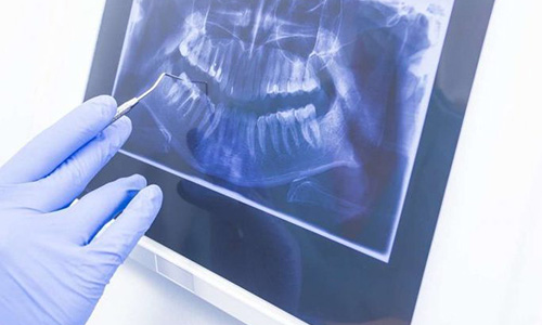 pemeriksaan panoramik, foto rontgen gigi, rumah sakit awal bros, rs awal bros