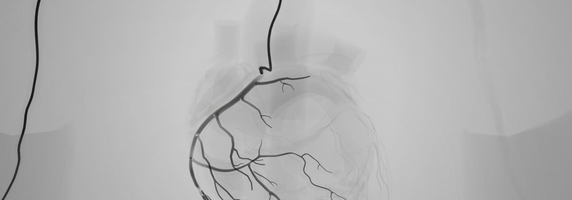 PTA (Percutaneus Transluminal Angiography)