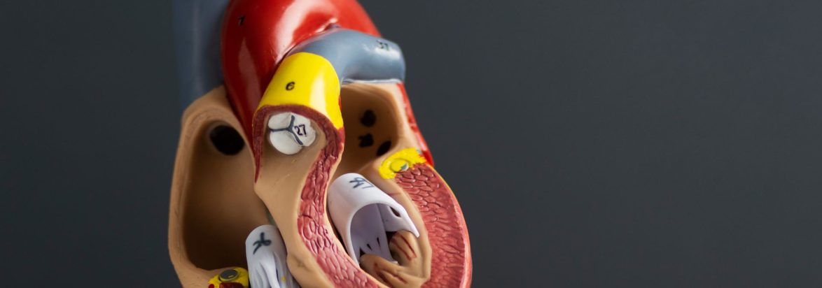 Percutaneus Transvenous Mitral Commissurotomy (PTMC)Balloon Mitral Valvulotomy
